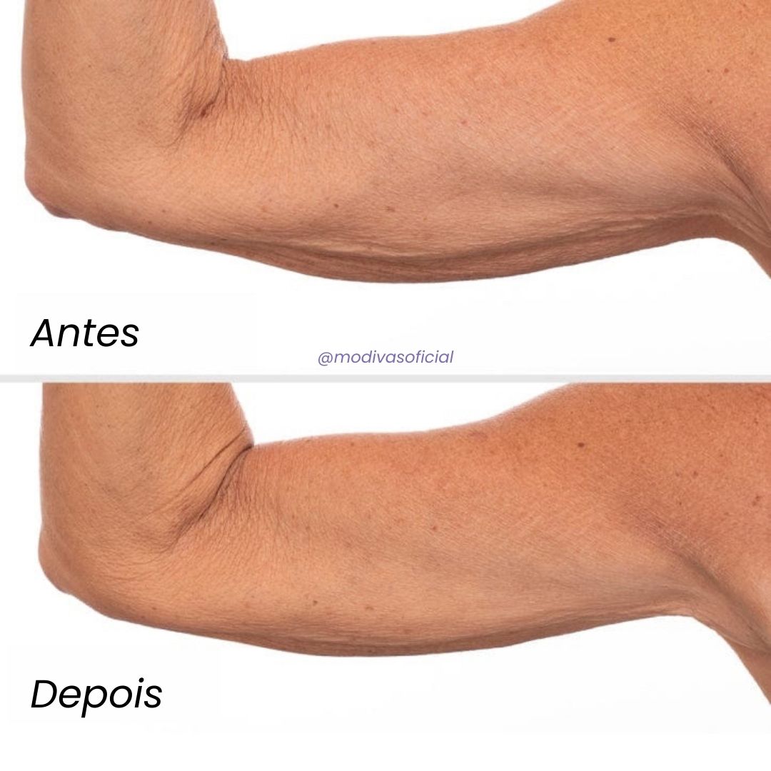 Creme Anti-Estrias e Flacidez Sculpt & Tone GOPURE / PELE E AUTOESTIMA 100% RECUPERADA