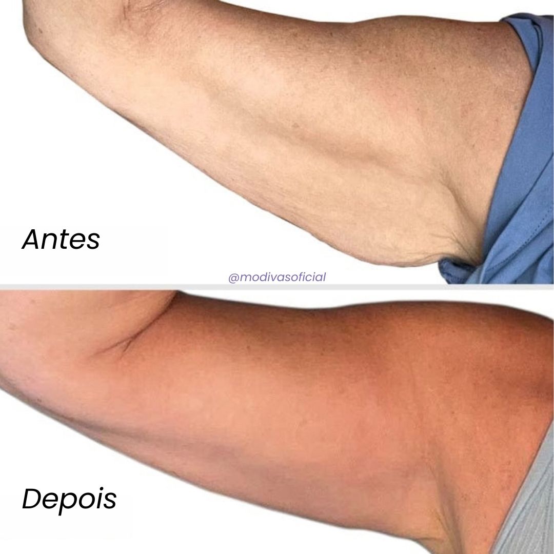 Creme Anti-Estrias e Flacidez Sculpt & Tone GOPURE / PELE E AUTOESTIMA 100% RECUPERADA