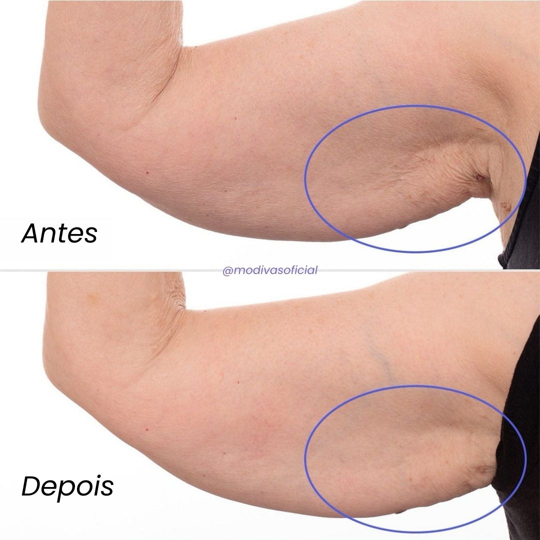 Creme Anti-Estrias e Flacidez Sculpt & Tone GOPURE / PELE E AUTOESTIMA 100% RECUPERADA